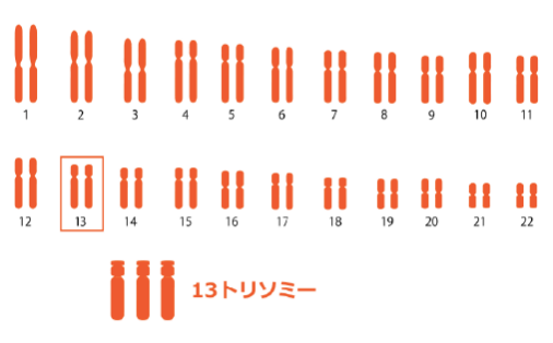 パトウ症候群（13トリソミー）