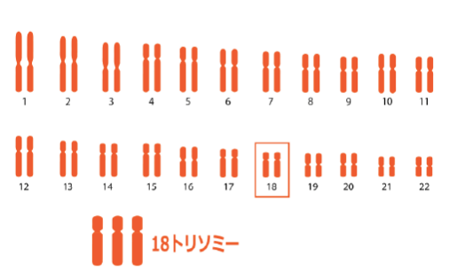 エドワーズ症候群（18トリソミー）