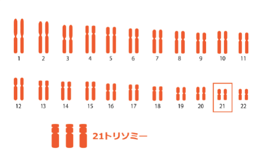 ダウン症（21トリソミー）